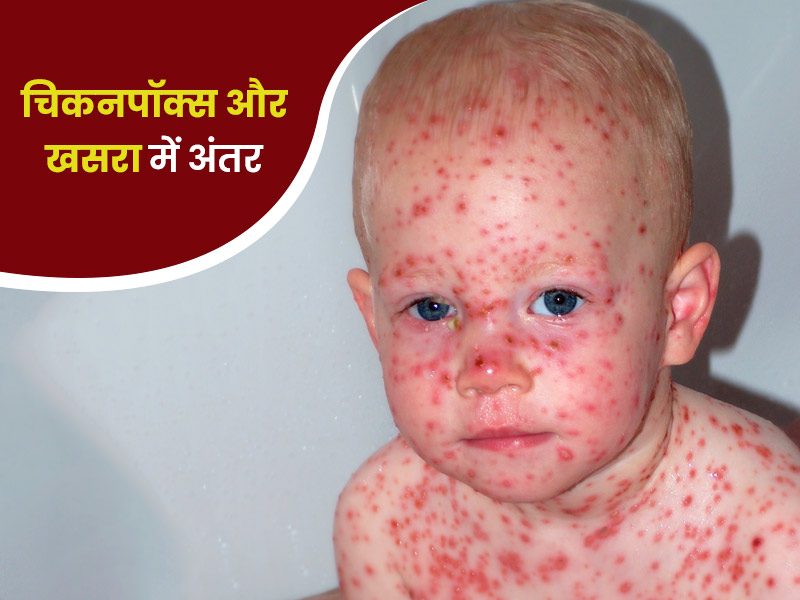 खसरा और चिकनपॉक्स दोनों में त्वचा पर दिखाई देते हैं लाल दाने, जानें इन बीमारियों के बीच अंतर
